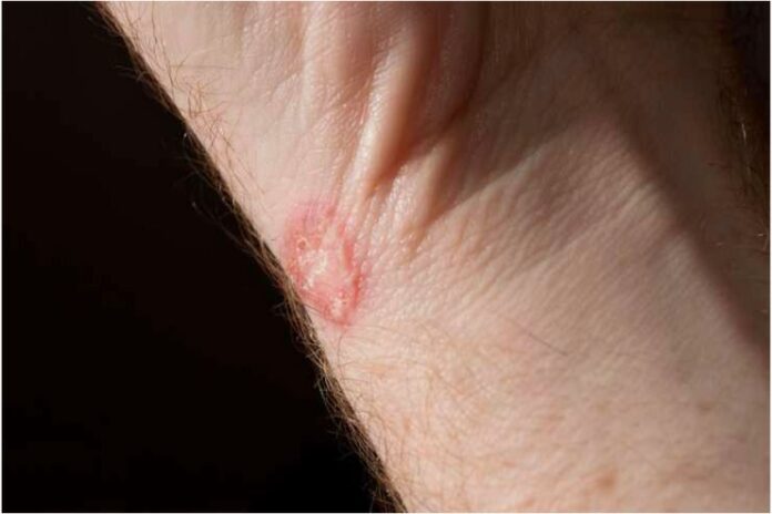 Ringworm or tinea fungal infection