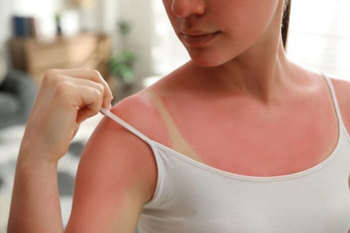 Home Remedies For Sun Poisoning